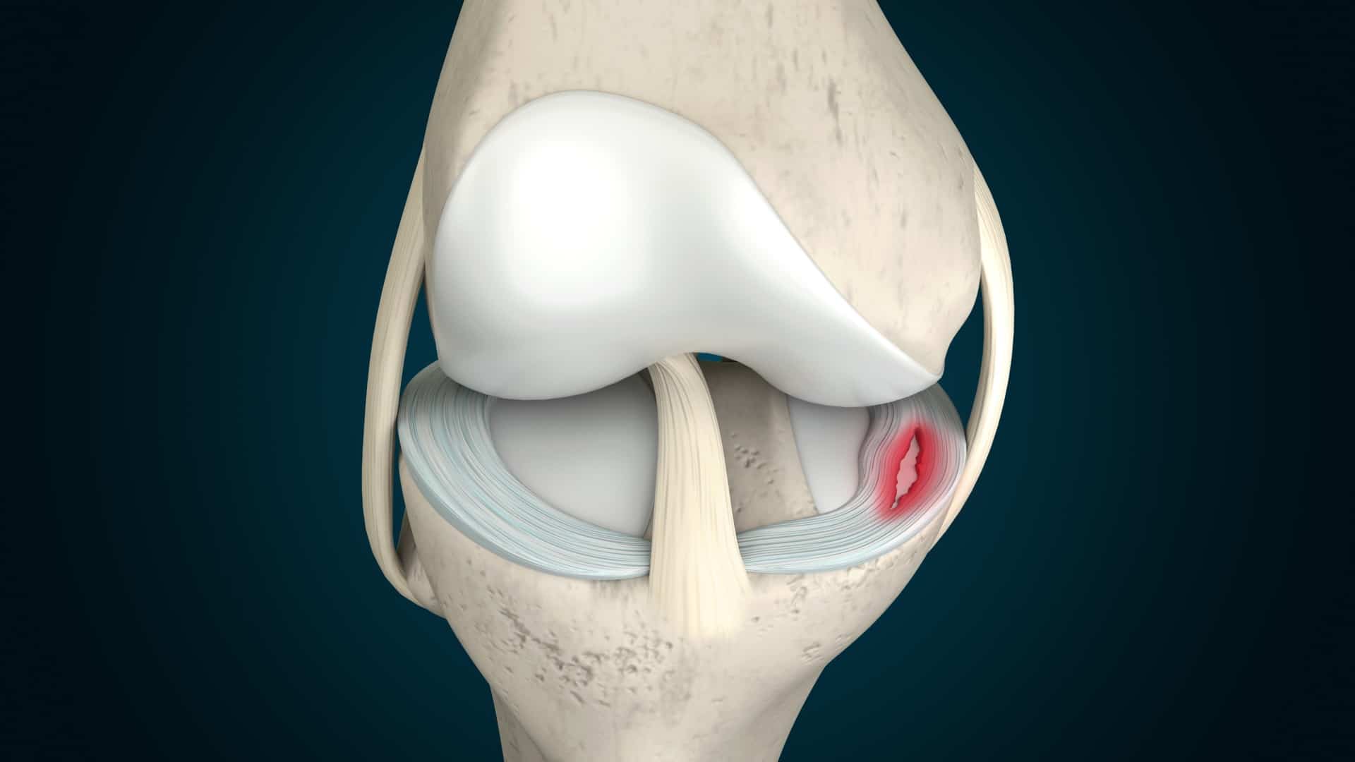 meniscus